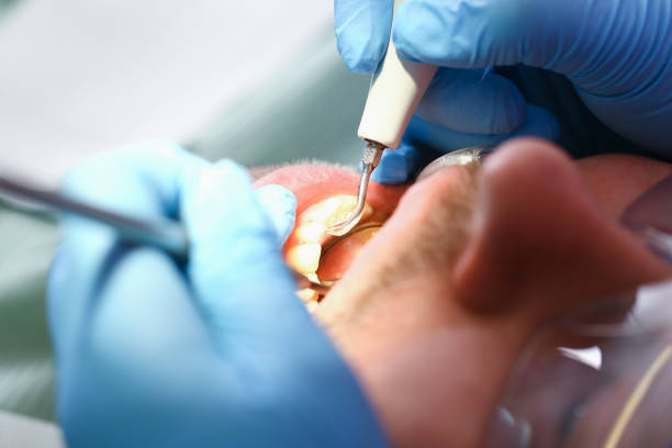 Best Emergency Dentist for Knocked-Out Tooth in Endwell, NY